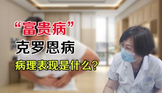 什么人容易得克罗恩病(什么人容易得克罗恩病喝酒)