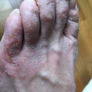 脚上起小水泡还很痒是什么原因(脚上起小水泡还很痒是什么原因引起的)，脚上起小水泡且很痒的原因，脚上起小水泡且很痒的原因分析
