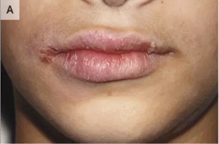 什么是克罗恩病最常见症状(什么是克罗恩病听说克罗恩病是一)